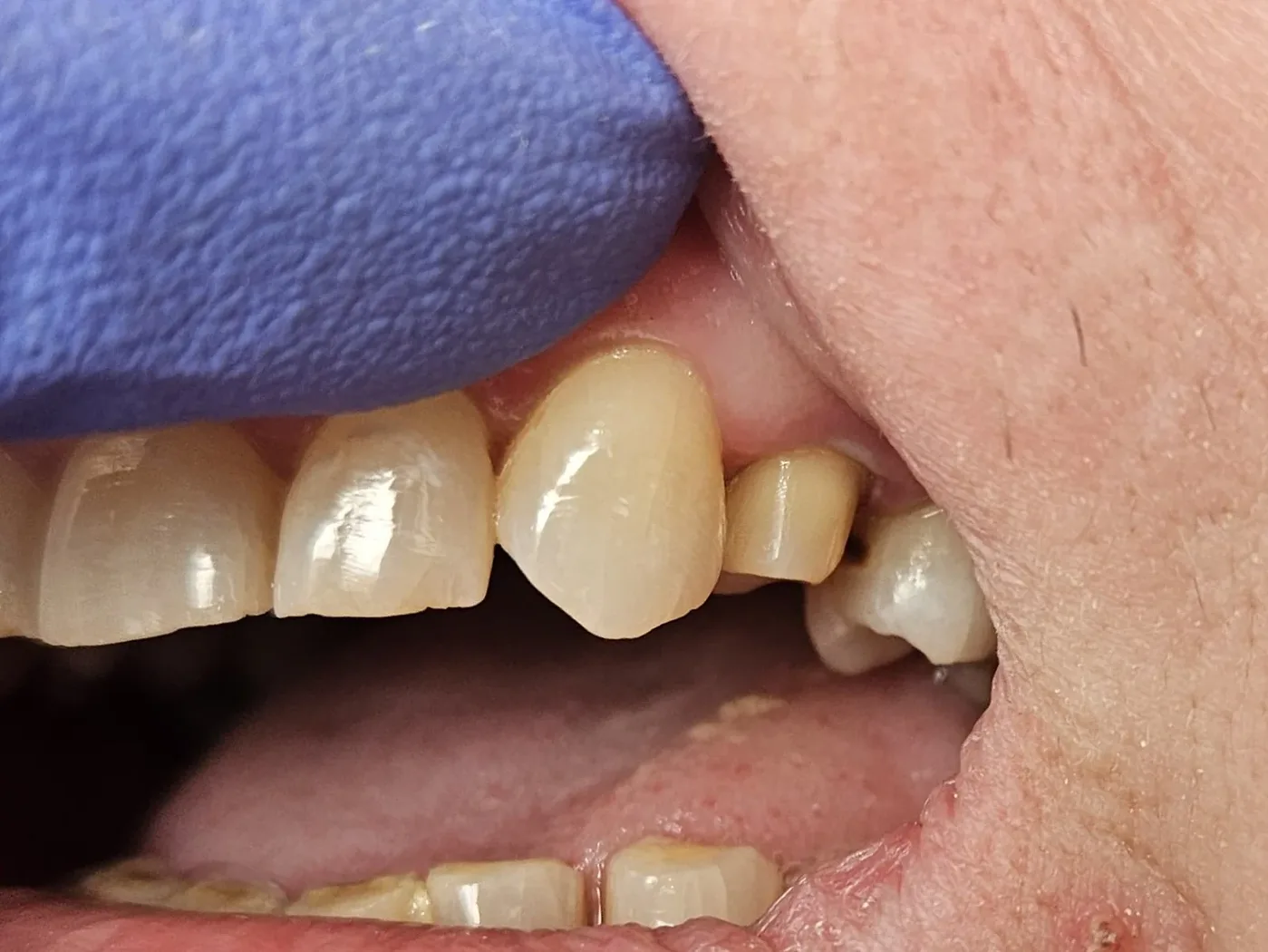 Před: Zirconia — tooth #24