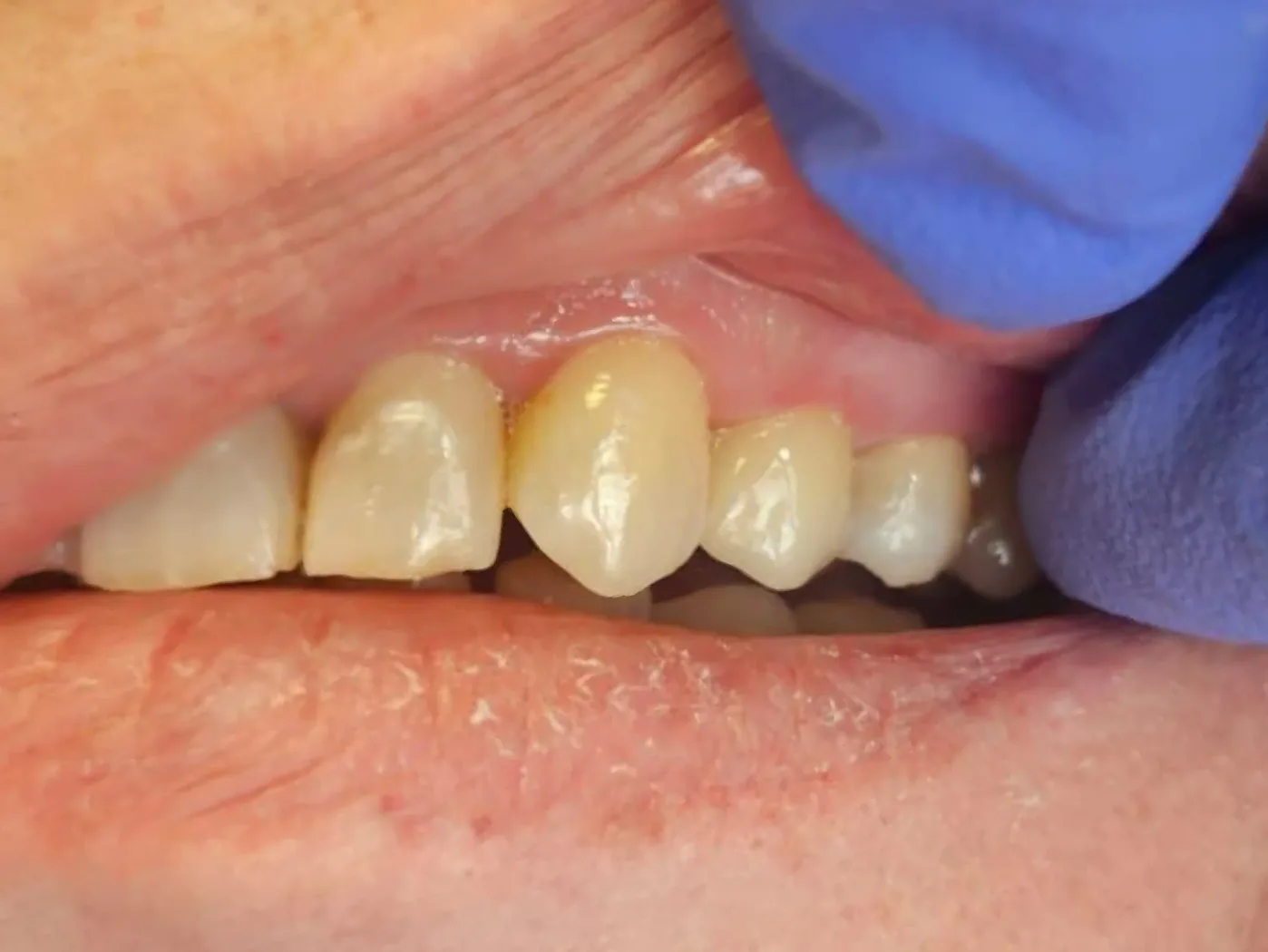 Po: Zirconia — tooth #24