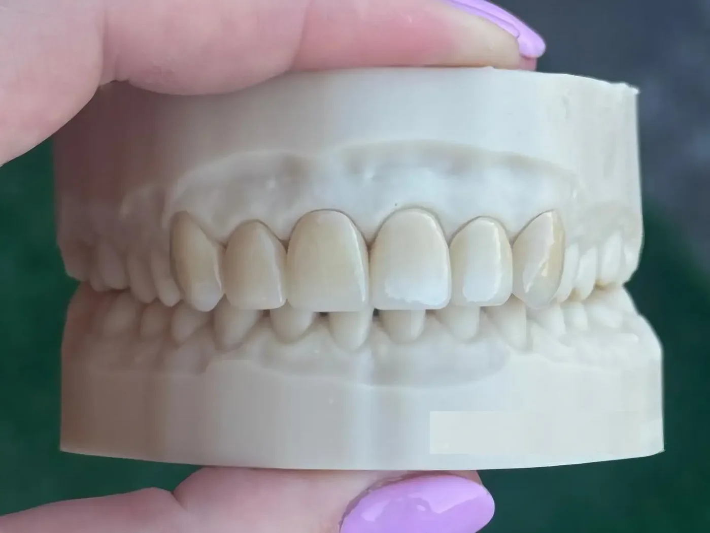 Před: Zirconia veneers