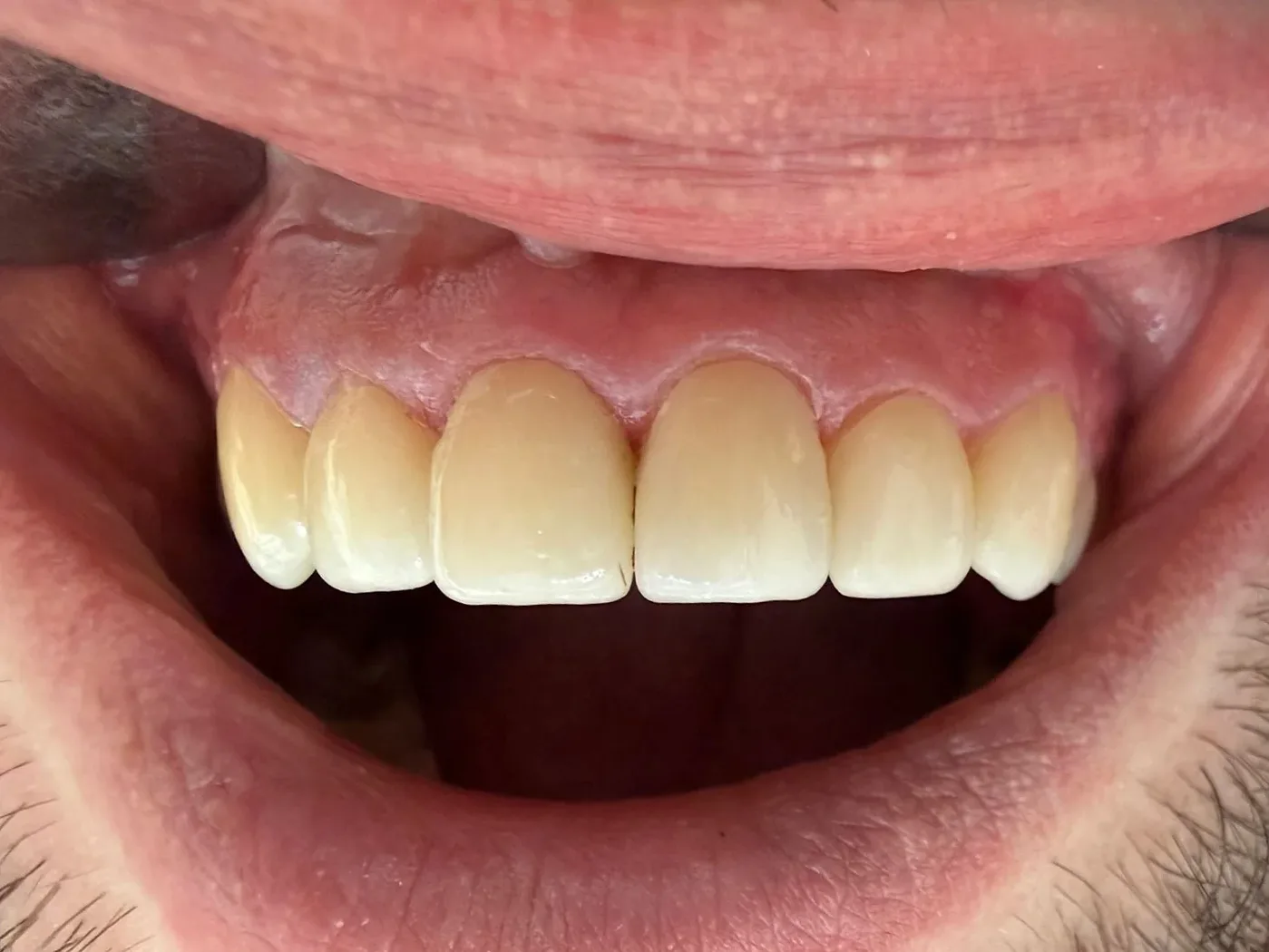 Po: Zirconia veneers