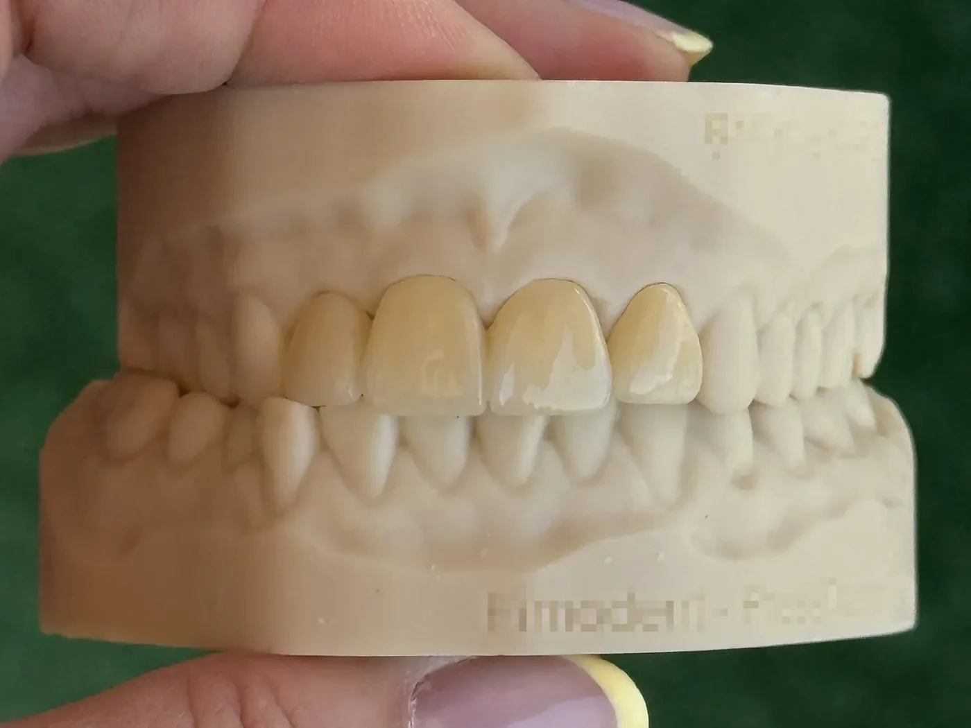 Anterior crowns on model