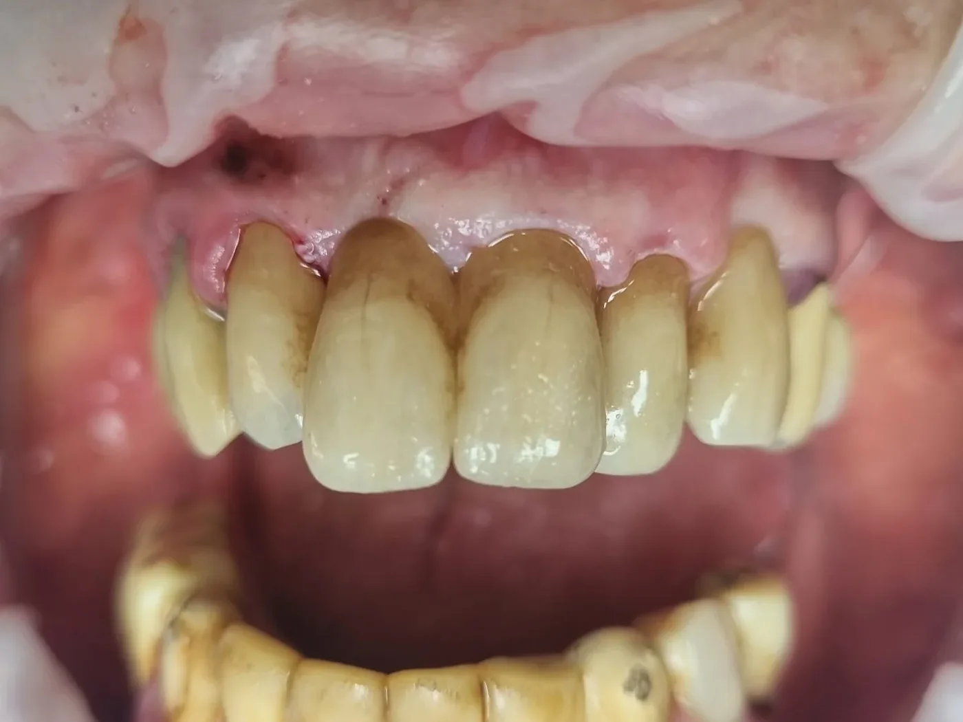 Pigmented anterior crowns