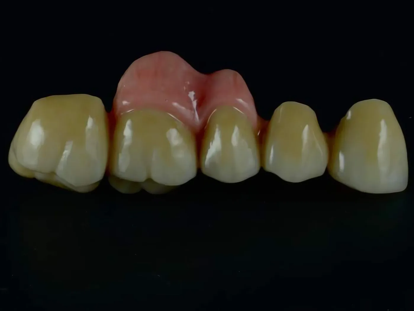 Fired gingiva I.