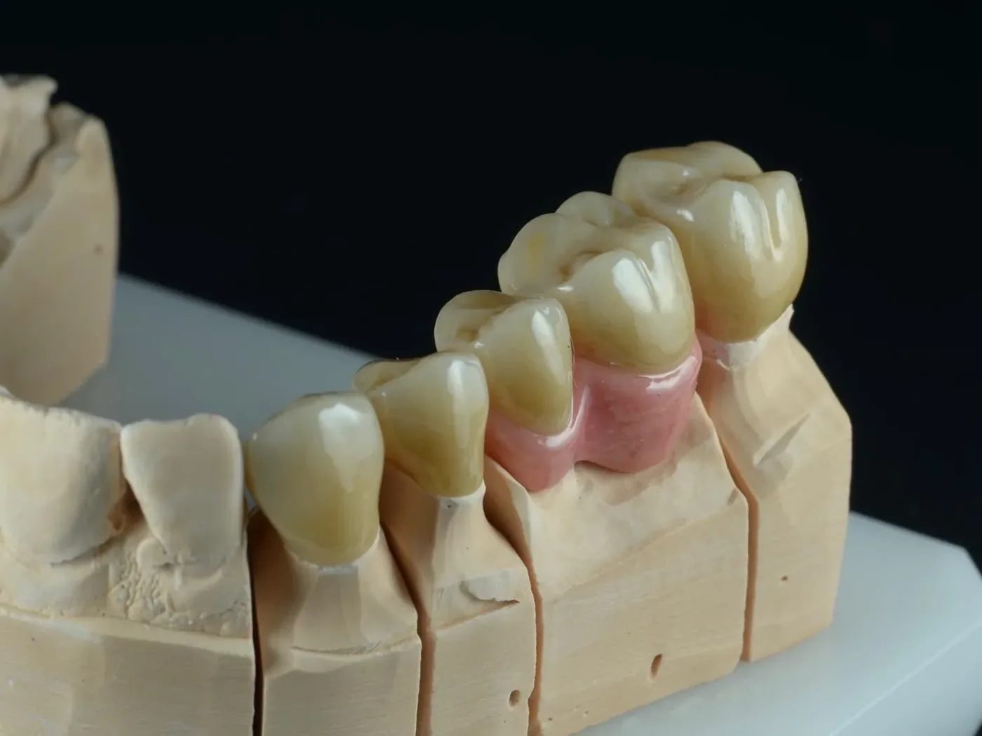 Fired gingiva II.