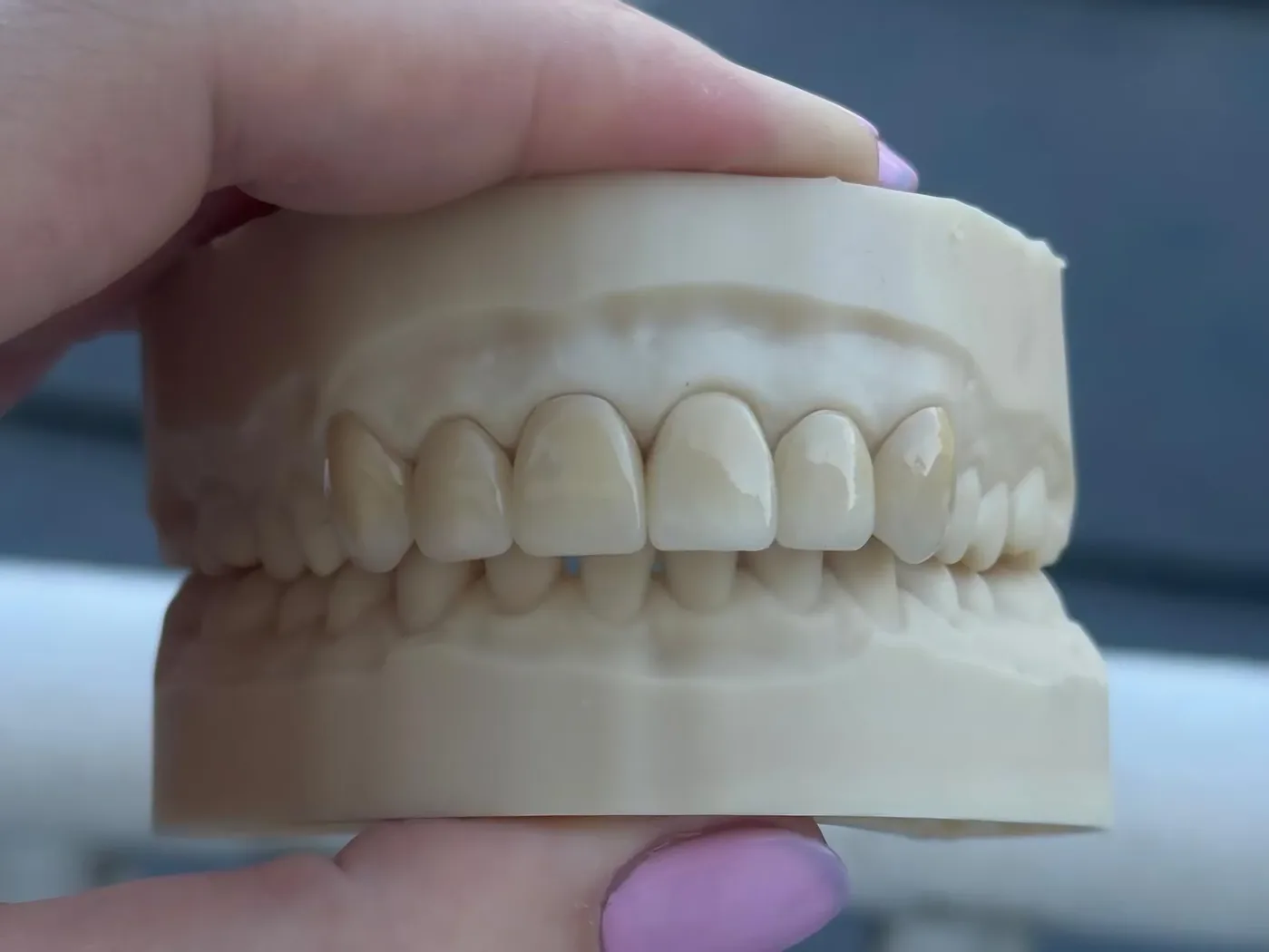 Zirconia veneers on model