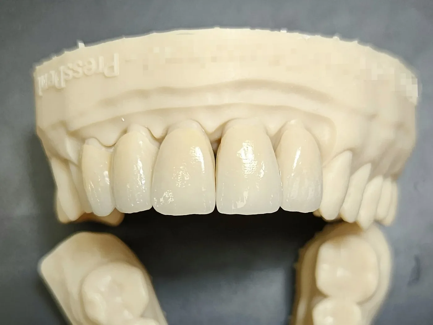 Anterior crowns — model work