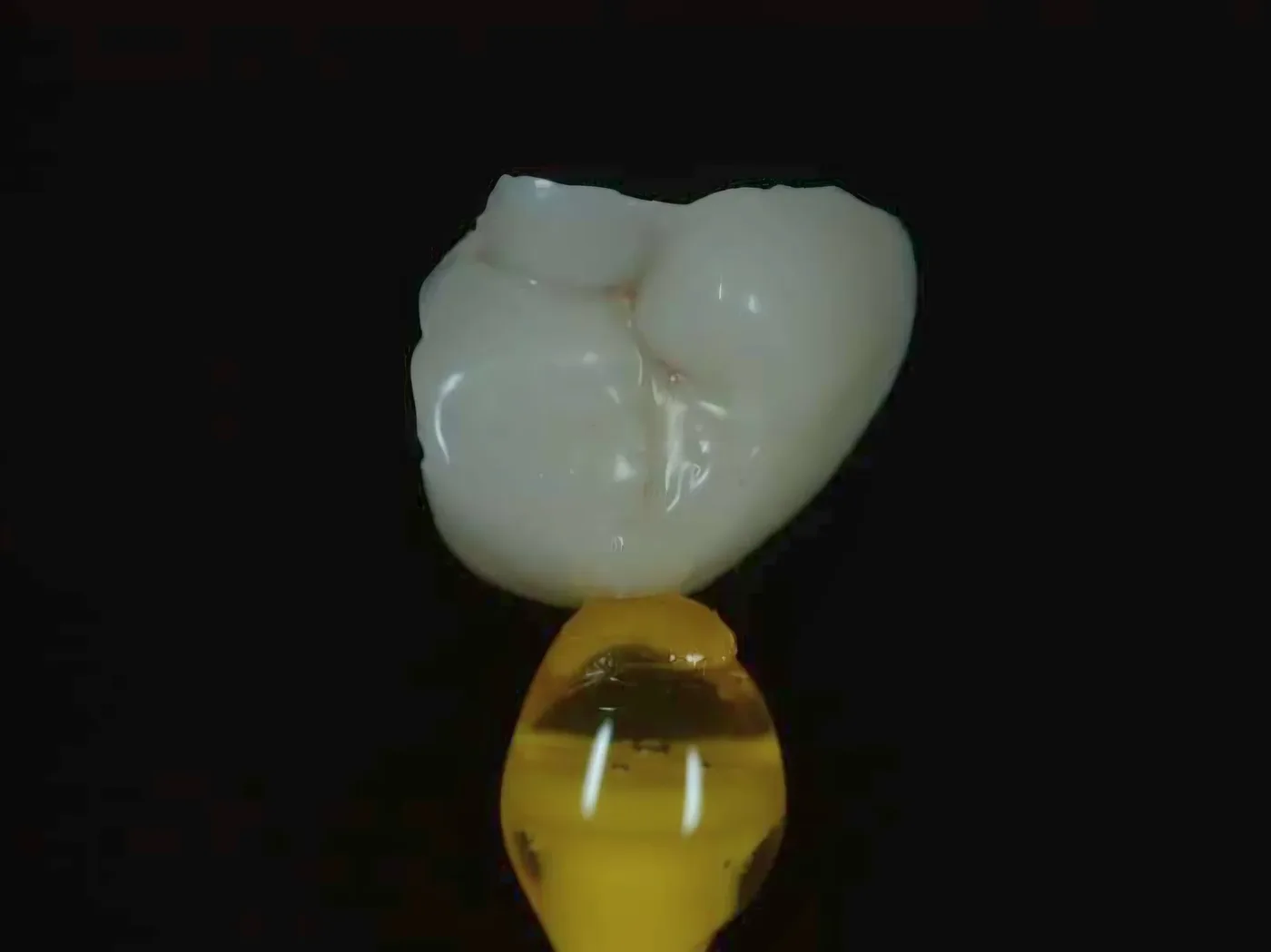 Composite onlay
