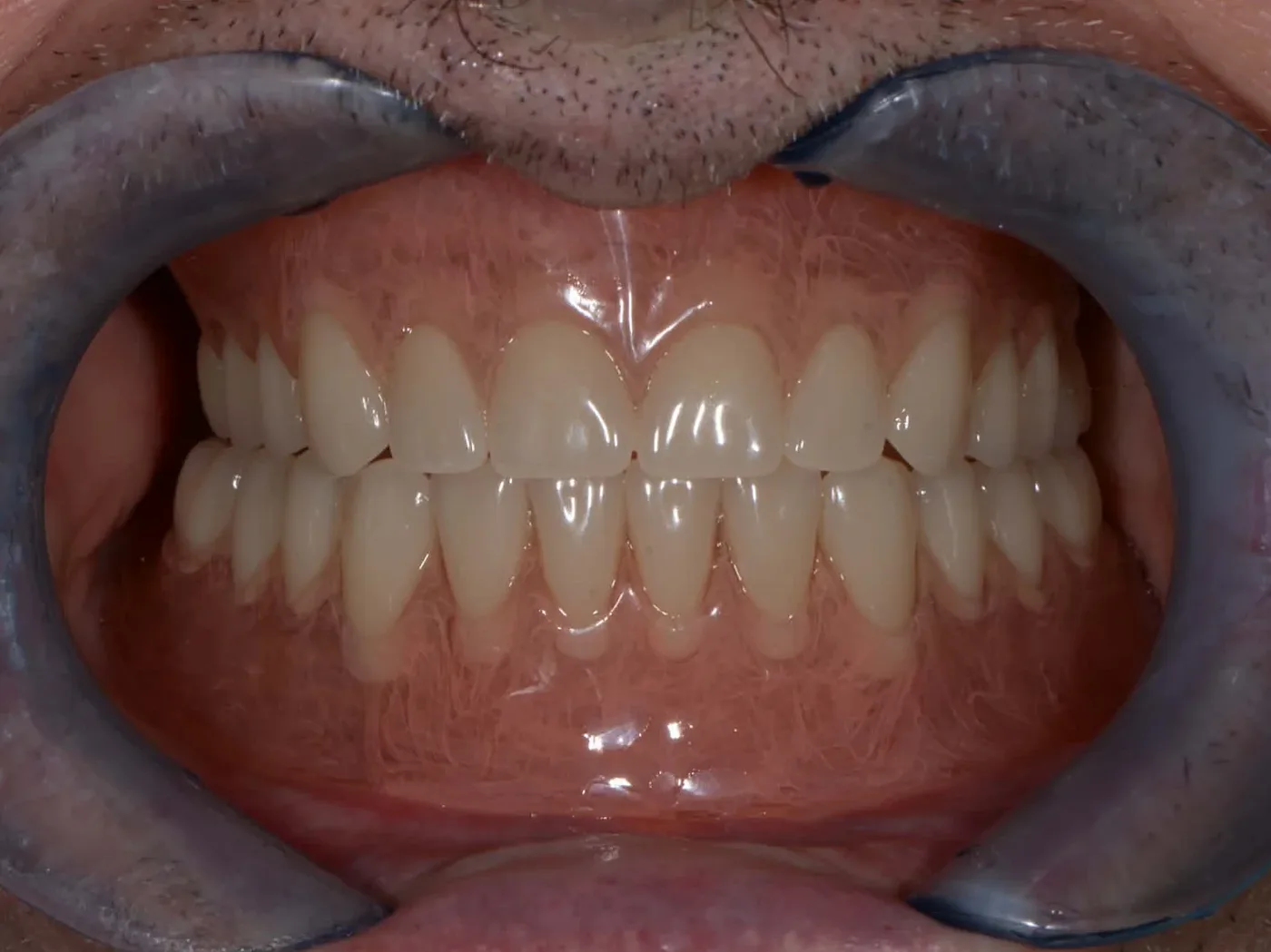 Deflex full dentures III.