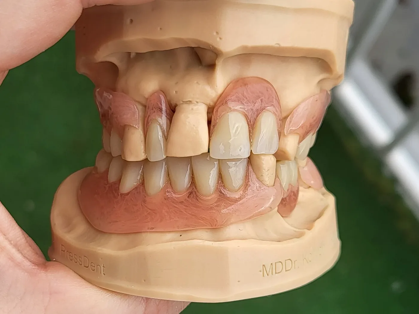 Upper & lower partial