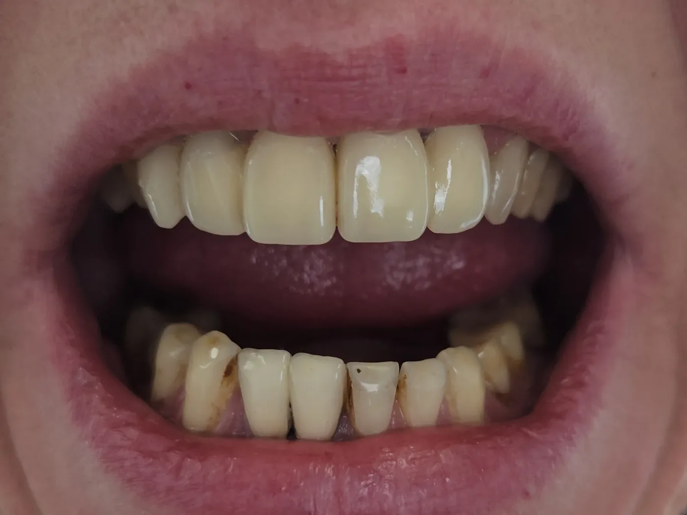 Před: Anterior crowns — VITA VM9