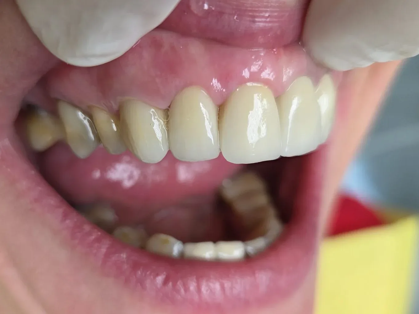 Po: Anterior crowns — VITA VM9